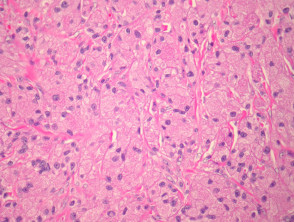 Patología del tumor de células granulares
