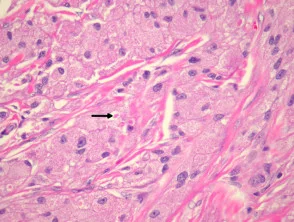 Pathologie van granulaire celtumoren