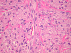 Patología del tumor de células granulares