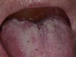 Ulceración bucal + glositis en granulomatosis con poliangeítis 