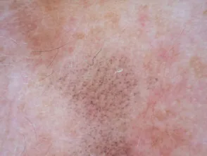 Patrón granular anular visto en dermatoscopia de queratosis similar a liquen plano