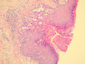 Dermatosis acantolítica transitoria o patología de la enfermedad de Grover