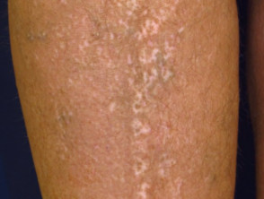 Vitiligo guttata