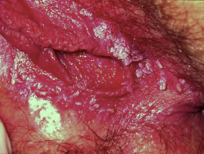 Verrugas genitales