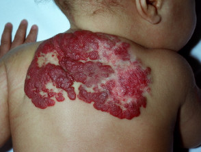 Hemangioma proliferativo infantil
