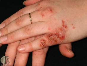 Dermatitis de manos infectadas