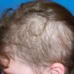 hairloss10__protectwyjqcm90zwn0il0_focusfillwzi5ncwymjisingildfd-6246339-8380486-jpg-8480377