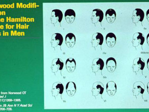 La clasificación de Norwood de alopecia de patrón masculino