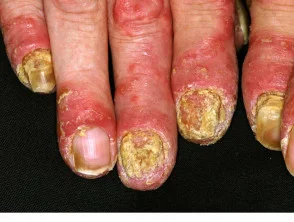 Hallopeau acrodermatitis continua