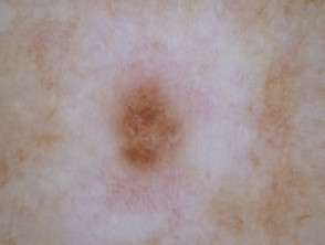 Dermatoscopia de halo nevus