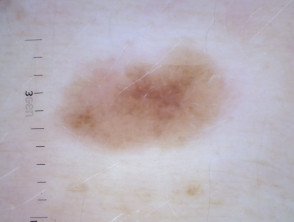 Dermatoscopia de halo nevus