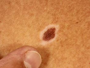 Halo nevus