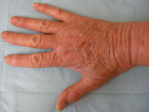 Handdermatitis door contactallergie voor thiuram in rubberen handschoenen