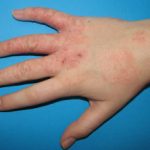 hand-dermatitis1__protectwyjqcm90zwn0il0_focusfillwzi5ncwymjisingildfd-4951068-3419710-jpg-7107419