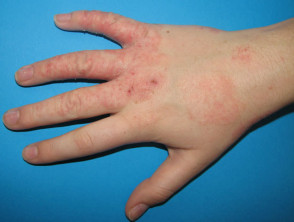 hand-dermatitis1__protectwyjqcm90zwn0il0_focusfillwzi5ncwymjisingildfd-4951068-3419710-jpg-7107419