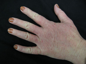 hand-dermatitis5__protectwyjqcm90zwn0il0_focusfillwzi5ncwymjisingildfd-9478784-7257349-jpg-7011331