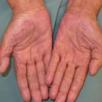 hand-voet-syndroom-1__protectwyjqcm90zwn0il0_focusfillwzi5ncwymjisingildbd-9675389-6899066-jpg-5419815