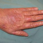 hand-foot-syndrome-2__protectwyjqcm90zwn0il0_focusfillwzi5ncwymjisingildbd-3911119-8663353-jpg-3967911