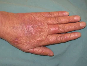 Sindrome dorsale mano-piede chemioterapica