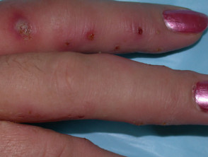 Vesiculaire dermatitis van geïnfecteerde hand