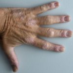 hand-psoriasis-01__protectwyjqcm90zwn0il0_focusfillwzi5ncwymjisingildfd-2827344-1506445-jpg-4430564