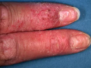 Handdermatitis