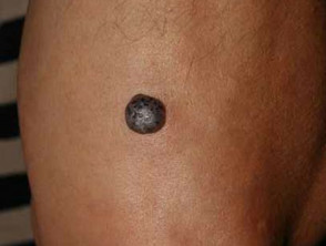 Hemangioma parecido al melanoma nodular