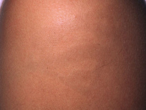 Reacción de henna negra que deja pigmentación.