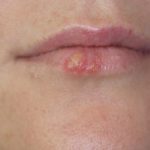 herpes-simplex-labialis-01__protectwyjqcm90zwn0il0_focusfillwzi5ncwymjisingilde5xq-4057583-3345572-jpg-4460313