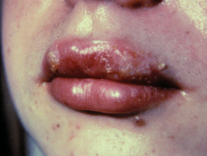 Herpes labial simple