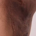 hidradenitis1__protectwyjqcm90zwn0il0_focusfillwzi5ncwymjisinkildg1xq-5654505-4116467-jpg-5853561