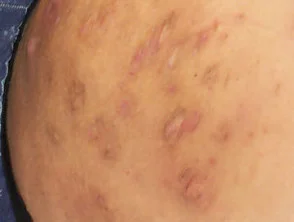 Hidradenitis suppurativa