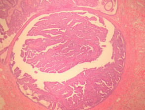 Pathologie von Hidradenoma papilliferum