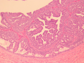 Hidradenoma papilliferum Pathologie