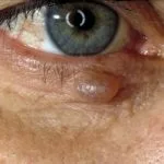 hydrocystoma-01__protectwyjqcm90zwn0il0_focusfillwzi5ncwymjisingildrd-4100849-2933129-jpg-9266993