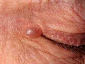 Hydrocystoma