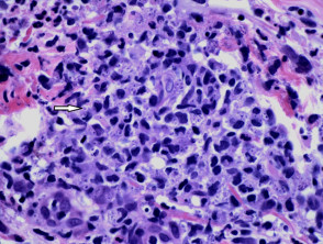 Histoplasmose-Pathologie