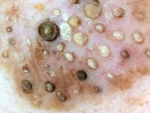 Dermatoscopia de queratosis seborreica