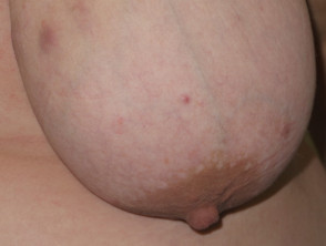 Hidradenitis supurativa de mama