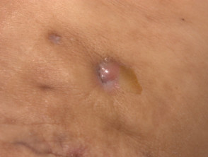 Cicatrización en hidradenitis supurativa