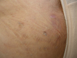 Cicatrización en hidradenitis supurativa