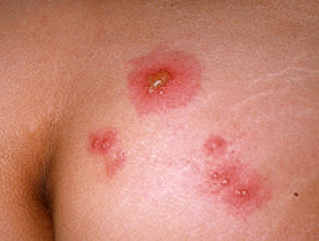 Herpes simplex 