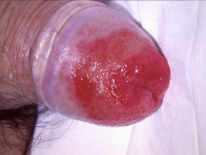 Lesión epitelial escamosa de alto grado del pene