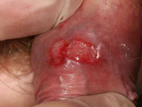 Herpes simple del pene