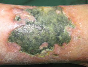 Úlcera de pierna inducida por hidroxiurea