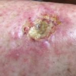 hydroxyurea-ulcer2__protectwyjqcm90zwn0il0_focusfillwzi5ncwymjisingildfd-8475843-6344777-jpg-2484294