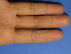 hyperkeratotic-hand-dermatitis-03__protectwyjqcm90zwn0il0_focusfillwzi5ncwymjisingildfd-4344339-6406125-jpg-4892648
