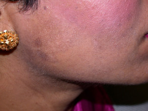 Dispigmentación posinflamatoria después de la depilación láser