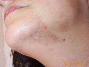 Hiperpigmentación posinflamatoria por acné