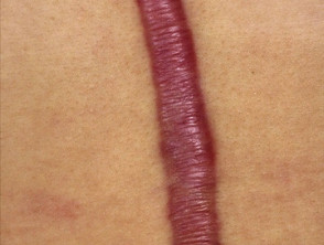 Cicatriz hipertrófica